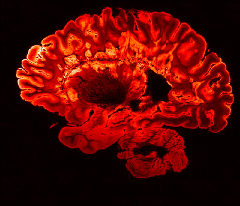 Covid-19 Brain