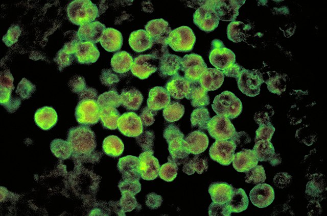 Brain-eating amoeba spreads northward, posing a threat to public health
