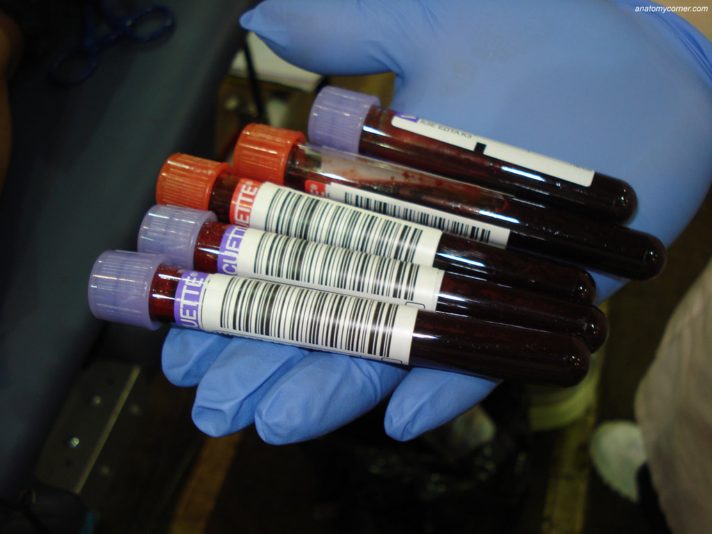 Multi-Cancer Blood Test Shows Real Promise