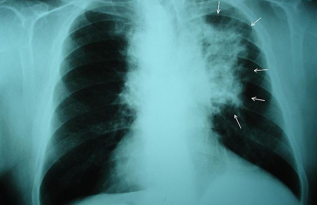 Scientists have discovered a pill that reduces the risk of death in type of lung cancer