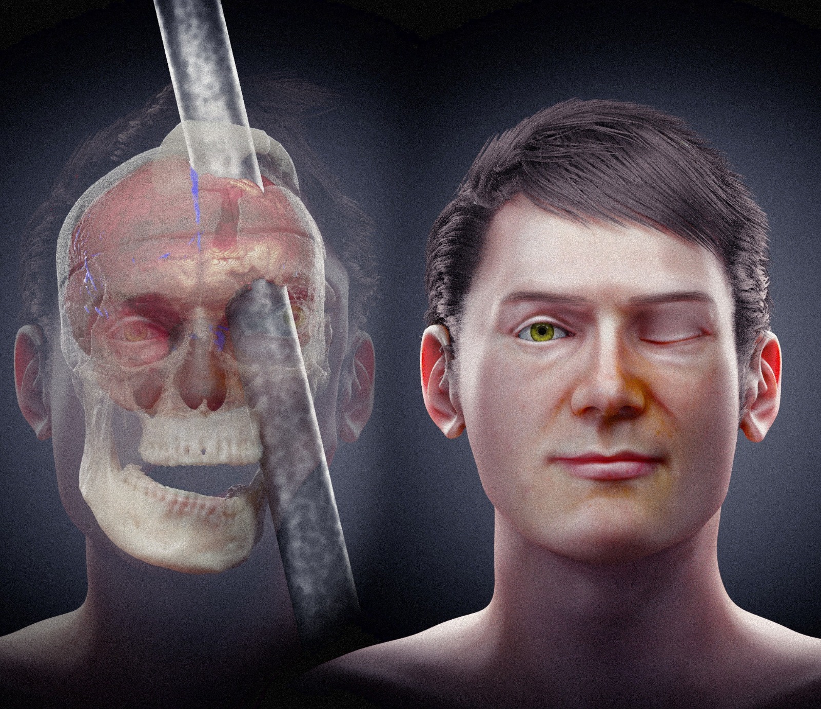 Scientists reconstruct the face of the man who had an iron rod incident