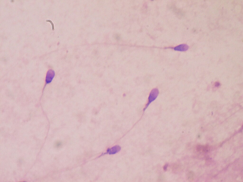 Human sperm cells stained for semen quality assessment