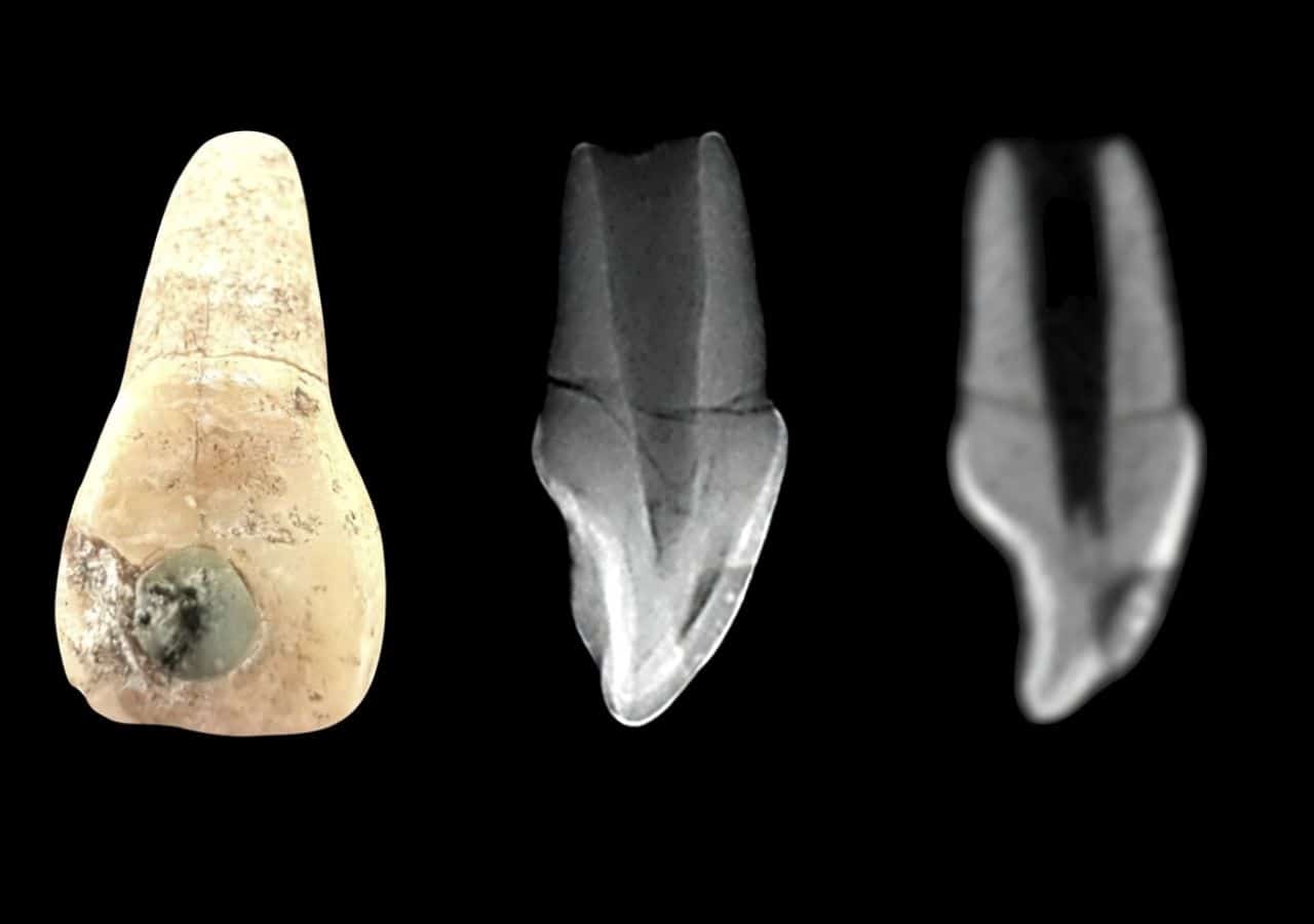 Scientists Discover Maya Created the World’s First Dental Filling Using Gemstones