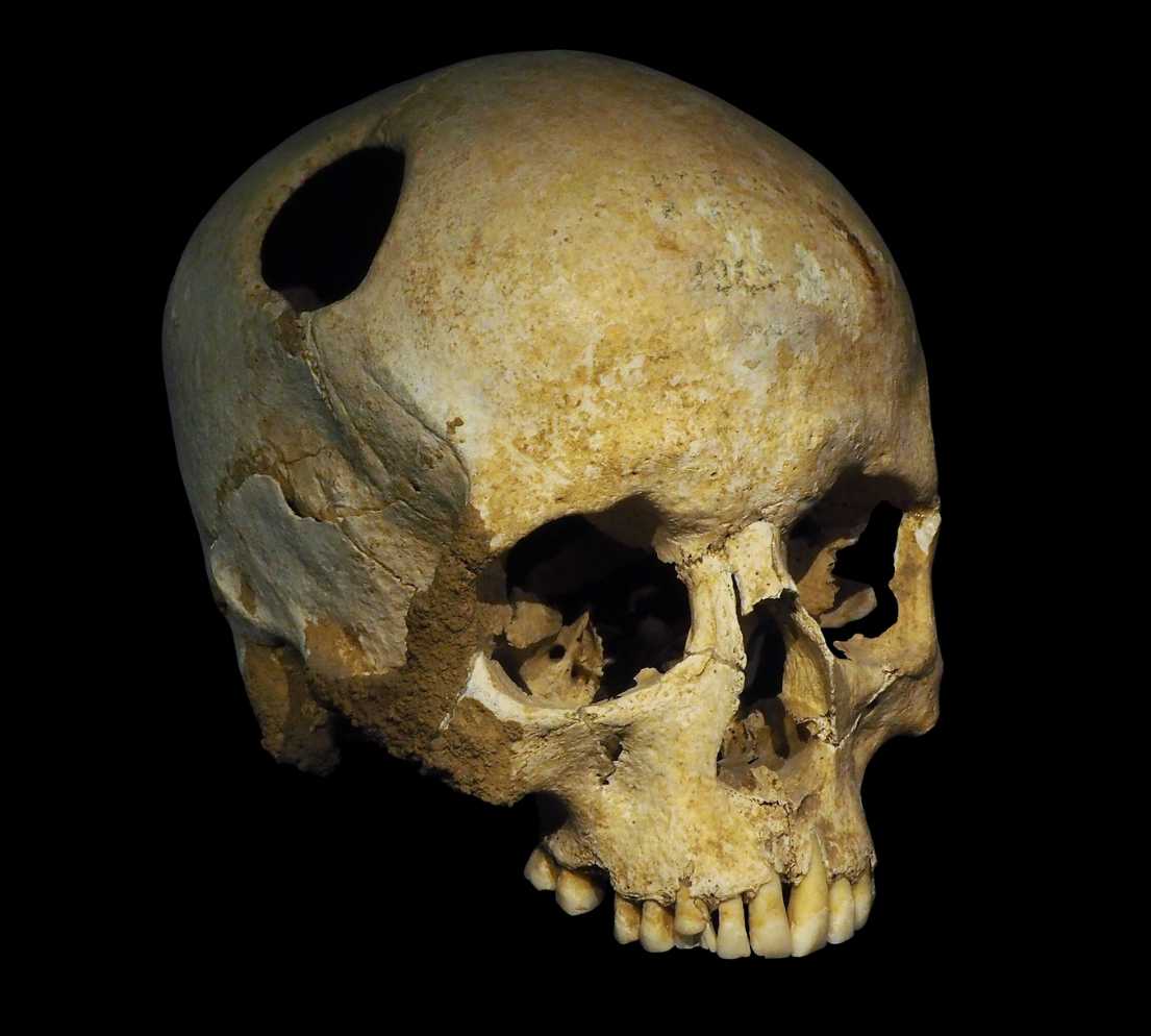4,000-Year-Old Child’s Skull Reveals Oldest Known Surgery in Central Asia
